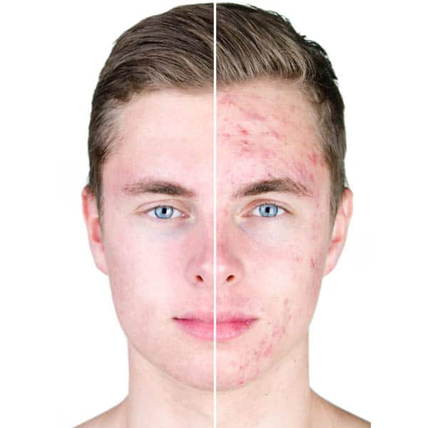 young male acne