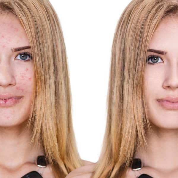 Teens and Acne - What you need to know - Mahoney Dermatology