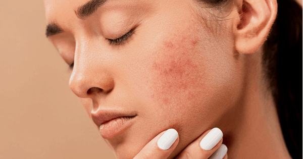 4 Common Skin Problems and How to Treat Them - Mahoney Dermatology