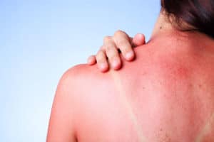 Sunburn skin on back
