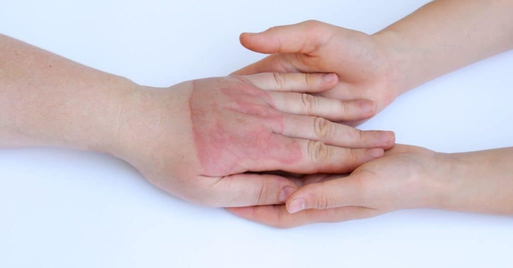 hands with burns