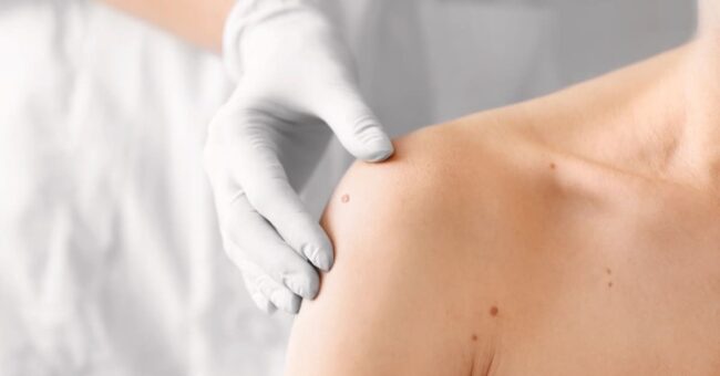 Dermatology woman's bare shoulder with white glove