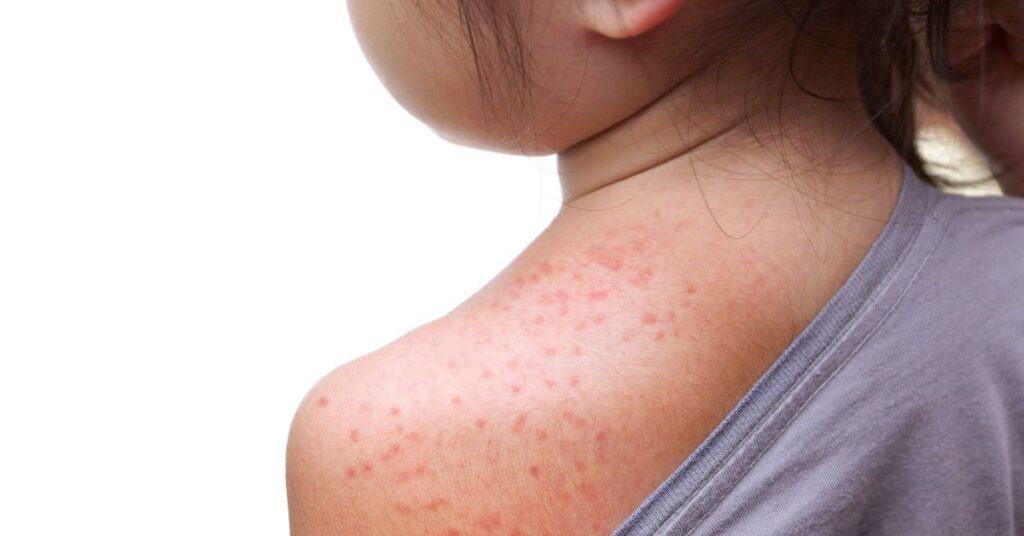 Measles on child's shoulder
