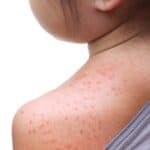 Measles on child's shoulder