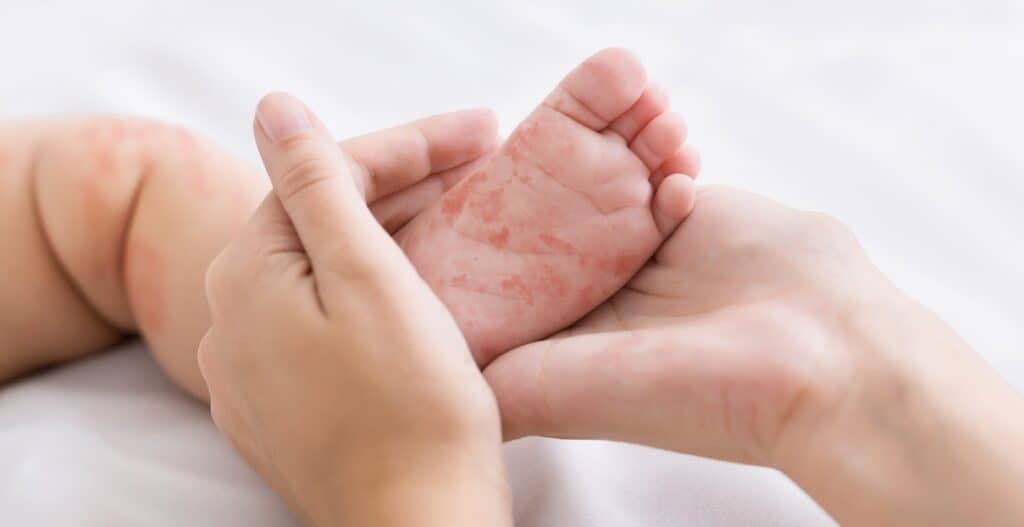 measles in flordia