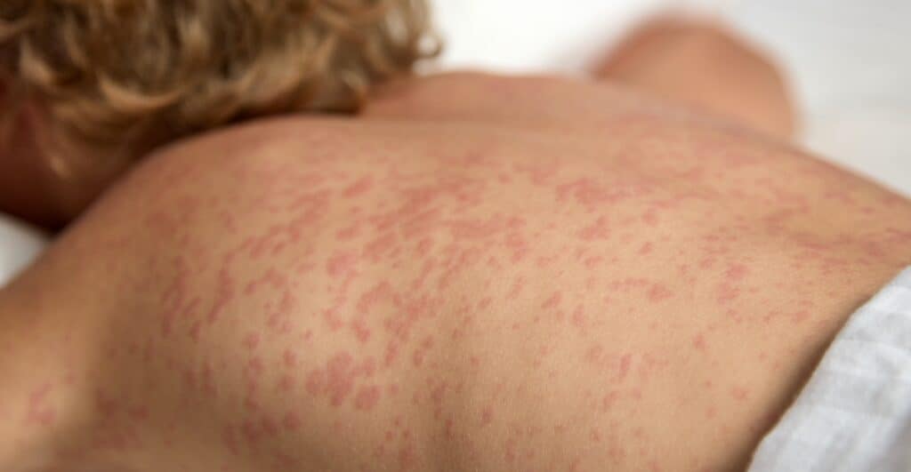 Measles rash