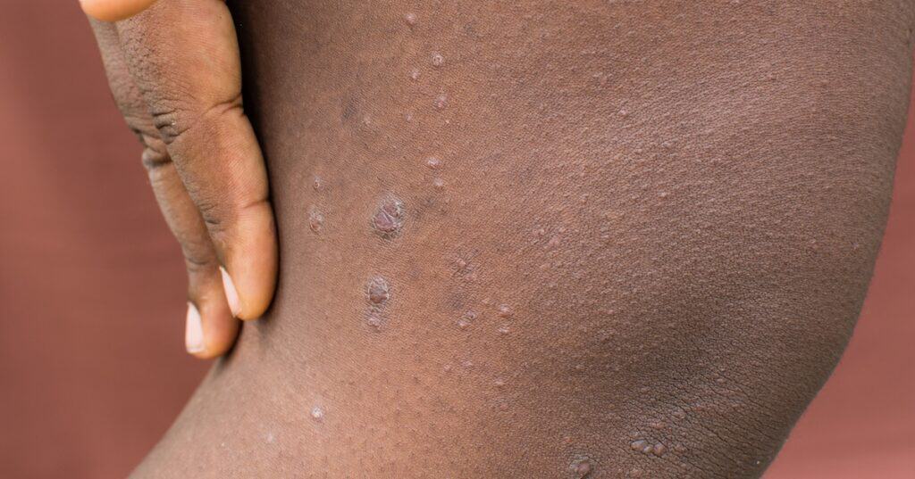 What is Prurigo Nodularis