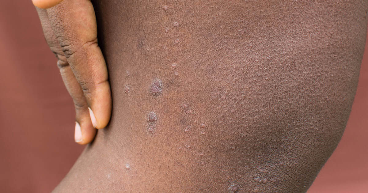What is Prurigo Nodularis